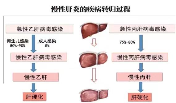 【健康科普】世界肝炎日——堅持早預(yù)防，加強檢測發(fā)現(xiàn)，規(guī)范抗病毒治療